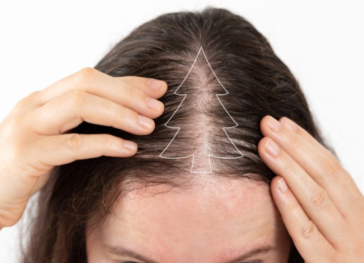 Alopecia femminile con pattern ad albero di Natale